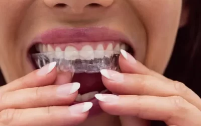 Invisalign orlando: Clear Aligner Therapy for Discreet Orthodontic Correction